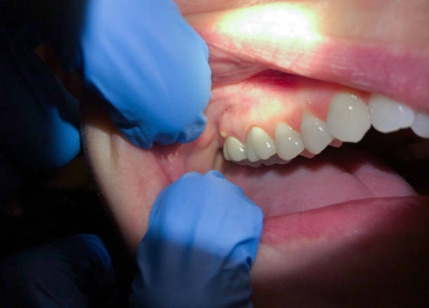 Best Broken or Chipped Tooth Repair in Huntington, TX